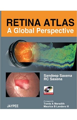 Retinal Atlas:A Global Perspective - (With Dvd  HB)